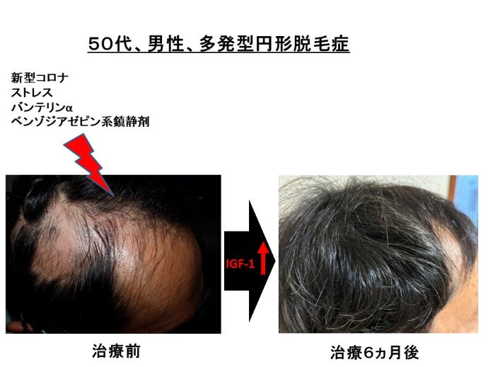 円形脱毛症　病院